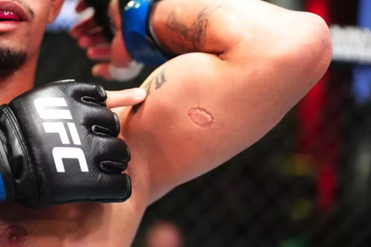 Šílený zkrat v UFC. Mladičký bojovník si zničil kariéru. Místo úderů použil zuby
